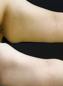 Underarm Tightening & Fat Reduction