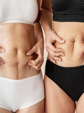 Body Contouring with Thermage