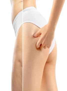 Thigh Lift and Cellulite Reduction with Accent XL