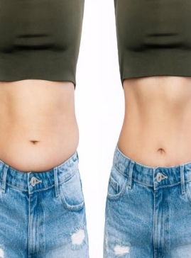 Tummy Tightening After Pregnancy or Surgery with Accent XL