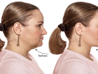 Why Accent XL Is Changing The Game For All Skin Types ?