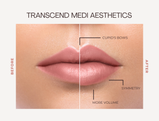 5 Crucial Tips, for Taking Care of Your Lip Fillers.