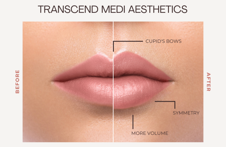 5 Crucial Tips, for Taking Care of Your Lip Fillers.