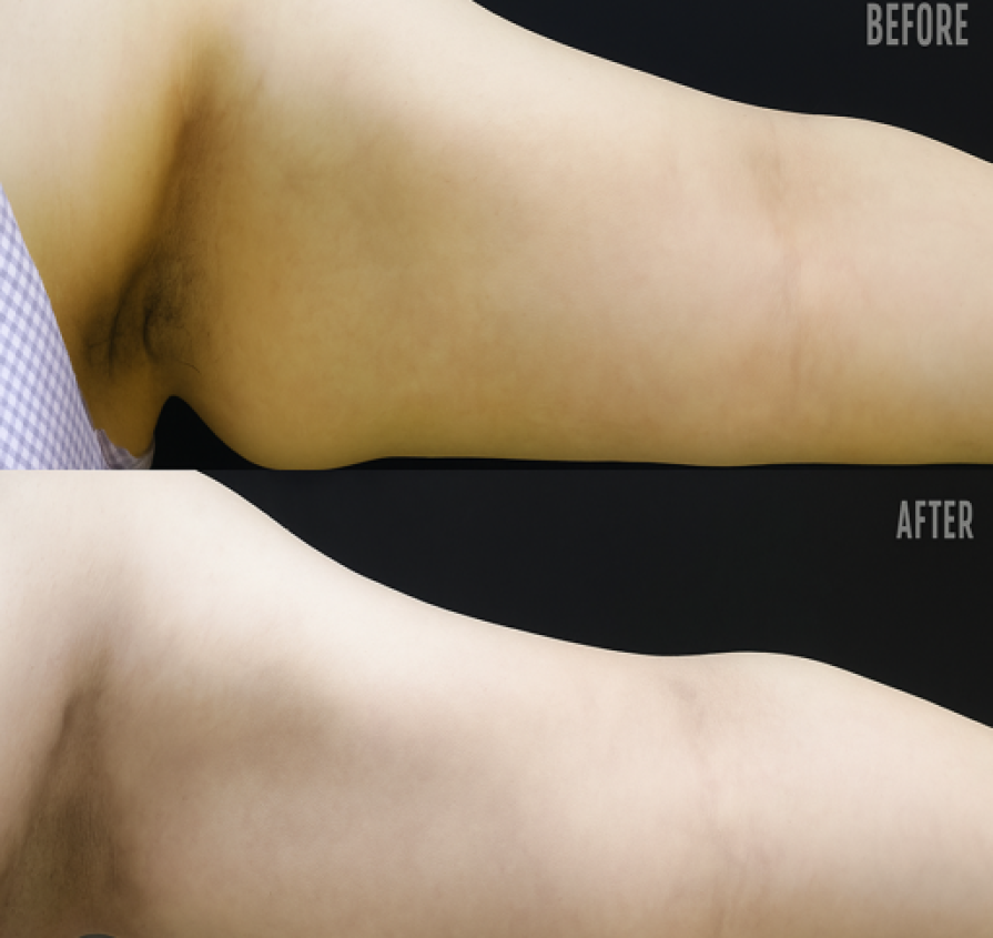 Accent XL tightens loose underarm skin, reduces fat, and smooths cellulite using RF heat—no surgery, no downtime, just firmer, sculpted arms in weeks.