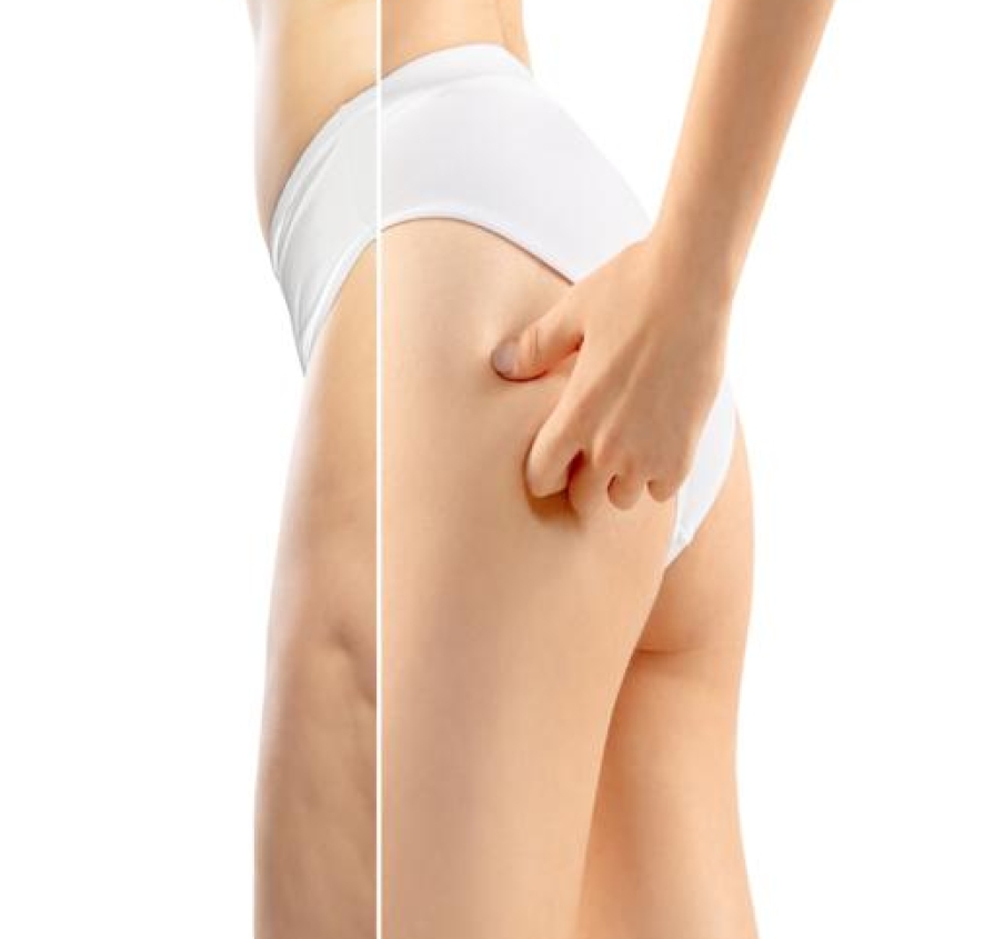 Non-surgical thigh lift with Accent XL. Reduce cellulite, tighten loose skin, and achieve smoother, firmer thighs with safe and effective RF treatment.