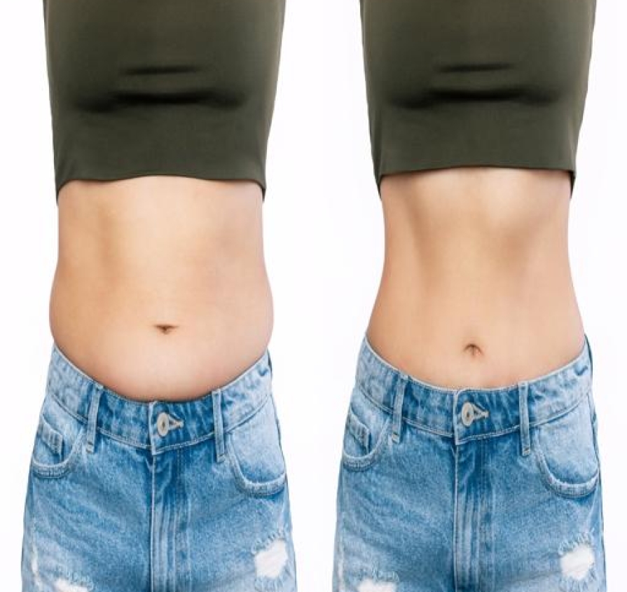 Tighten loose belly skin after pregnancy or surgery with Accent XL. A safe, non-surgical treatment for a firmer, smoother, and toned tummy.